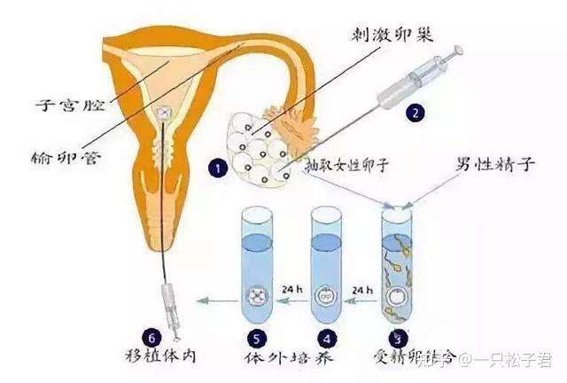 做试管怎么取精子(试管婴儿：如何取精子？)